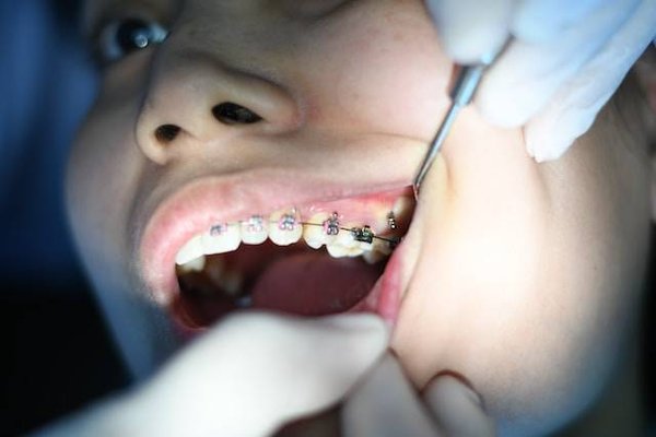 Comment choisir sa mutuelle santé pour le dentaire ?